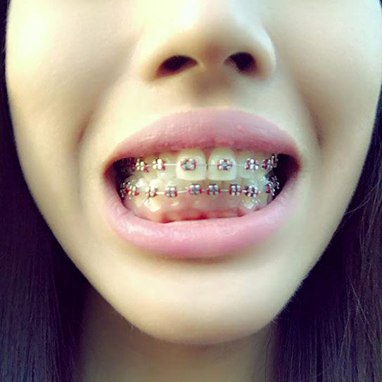 How Do Braces Actually Straighten Teeth? - MyOrthodontist - braces,lawrenceville braces Lawrenceville